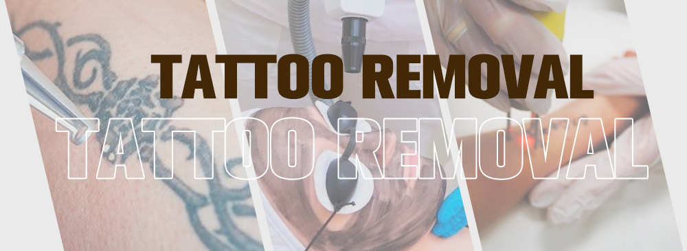 Tattoo Removal