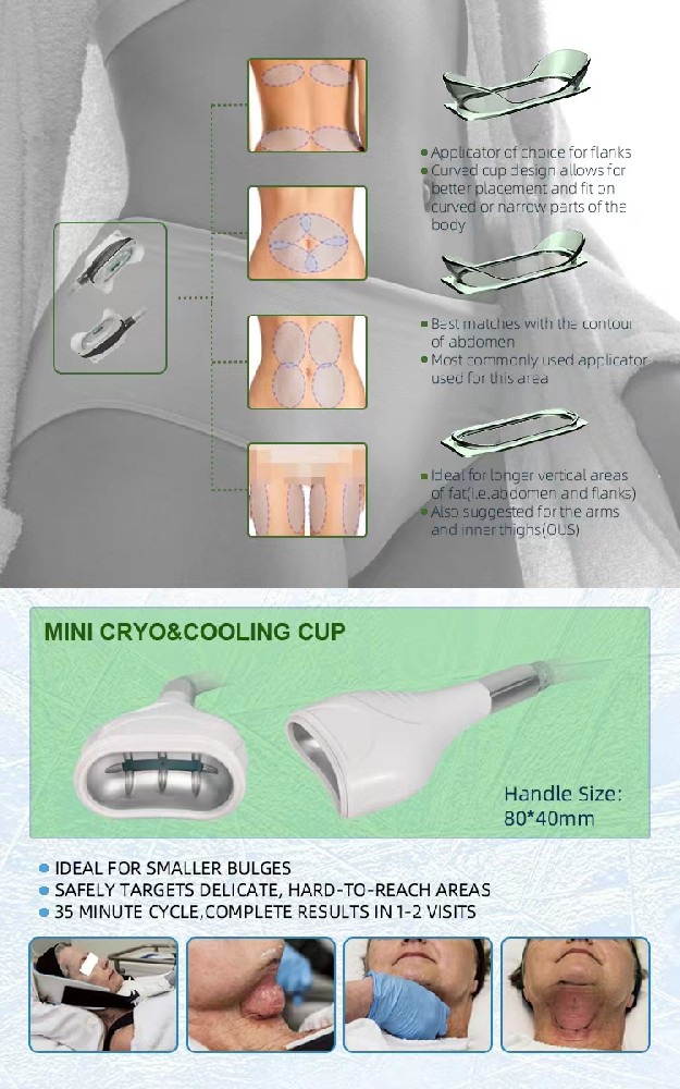 What is Cryolipolysis and treatment result?